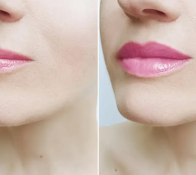 Przed i po zabiegu botox lip flip. Usta po zabiegu są pełniejsze i bardziej wyraziste.