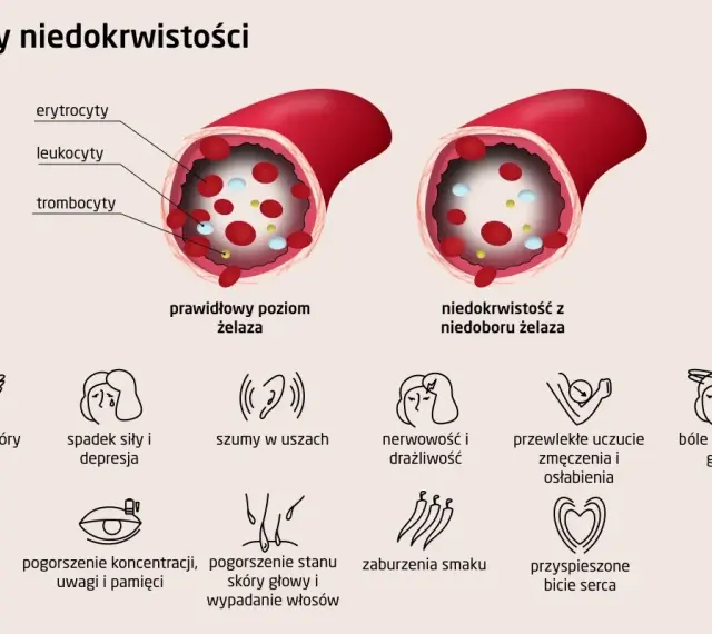 Prawidłowy poziom żelaza w naczyniu krwionośnym vs. niedobór żelaza. Objawy anemii: bladość, zmęczenie, szumy w uszach, bóle głowy.