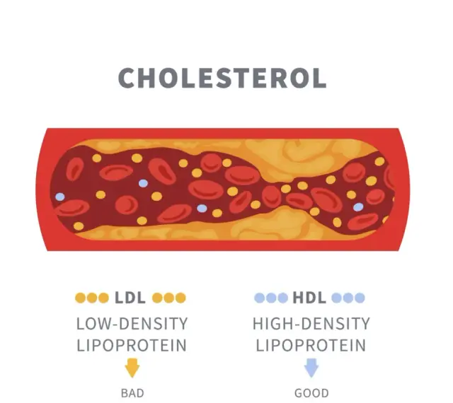 Przekrój naczynia krwionośnego z osadem cholesterolowym. Obok oznaczenia LDL (zły) i HDL (dobry) wskazują na normę cholesterolu całkowitego.