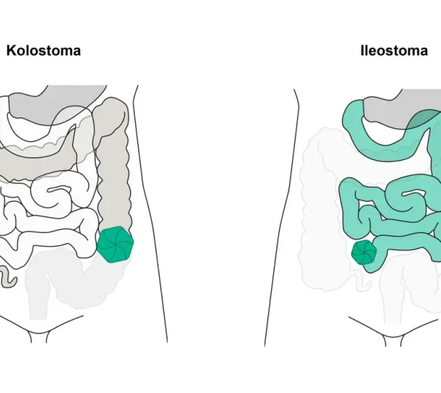 Vergleich von Kolostoma und Ileostoma: zwei stoma arten, die den Darm betreffen.