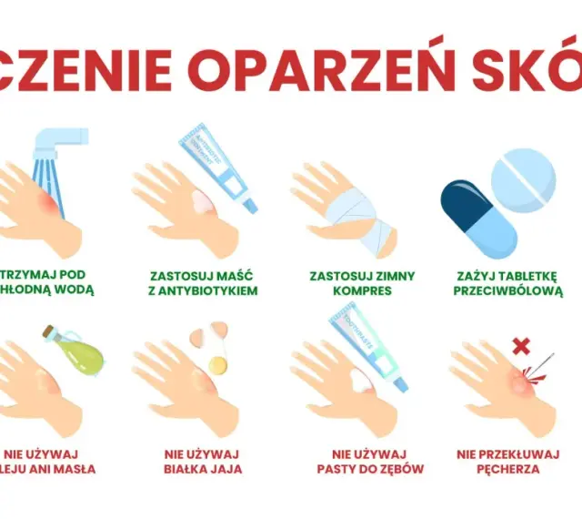 Leczenie oparzeń skóry: chłodna woda, maść z antybiotykiem, zimny kompres, tabletki przeciwbólowe, aloes. Unikaj masła, jajka, pasty do zębów, przekłuwania pęcherzy, lodu. Oparzenie 3 stopnia wymaga ostrożności.