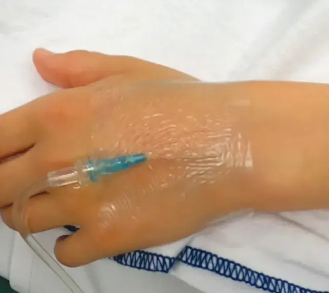 Ein Zugang am Handrücken, wo tut ein zugang am wenigsten weh? Hier wird ein Infusionsschlauch an einer Hand befestigt.