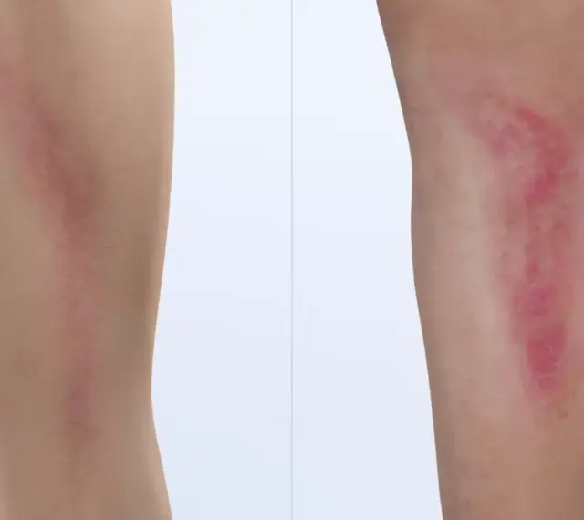 Vergleich zweier Beine: Links ein unauffälliger Bereich, rechts eine gerötete, geschwollene Stelle, die auf Thrombophlebitis Symptome hinweisen könnte.