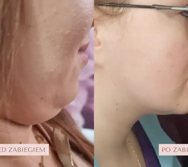 Przed i po zabiegu lipolizy podbródka. Widoczna redukcja tkanki tłuszczowej, wyraźniejsza linia żuchwy.