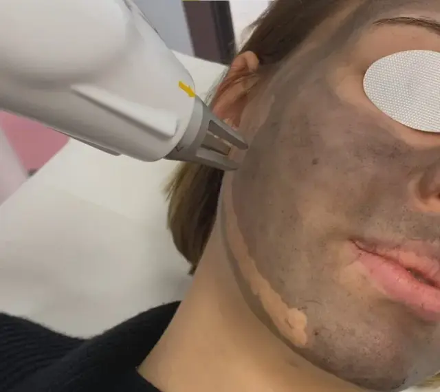 Zabieg laserowy na twarz z maską węglową. Skóra przygotowana do peelingu węglowego.