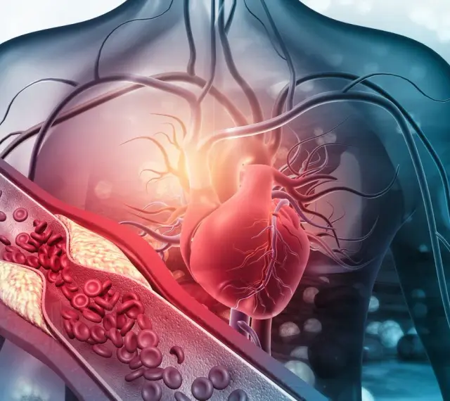 Zatkana tętnica z cholesterolem i czerwonymi krwinkami, obok czerwonego serca. Zrozumienie, po której stronie serce, jest kluczowe dla zdrowia.
