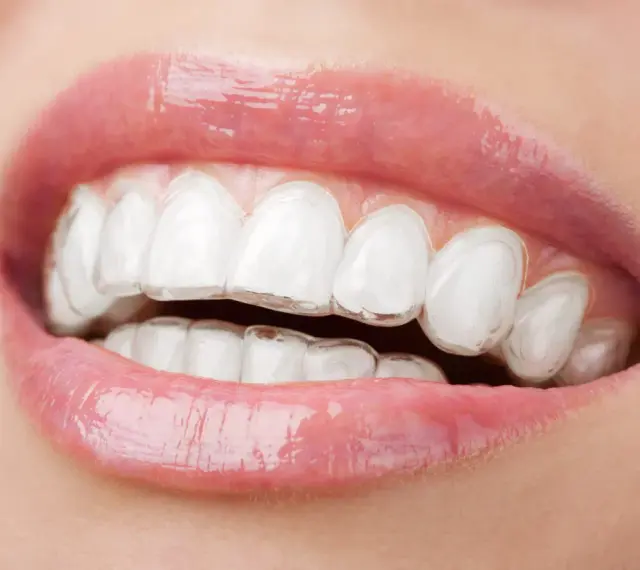 Zbliżenie na usta z widocznym aparatem Invisalign, który dyskretnie koryguje zgryz.