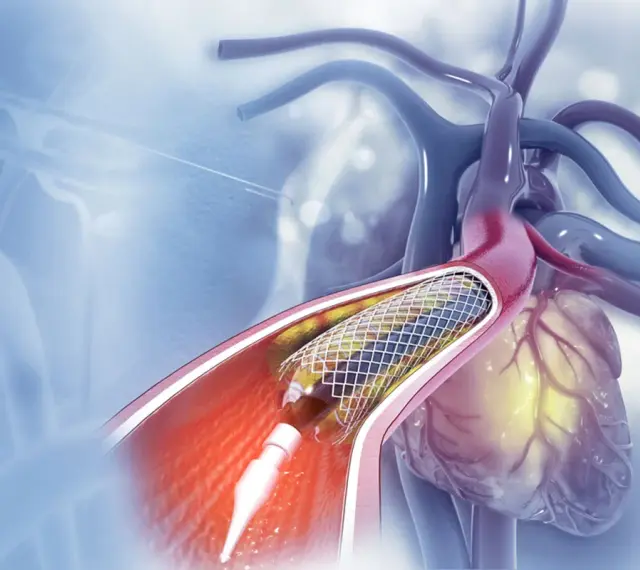 Stent w tętnicy serca podczas zabiegu angioplastyki.