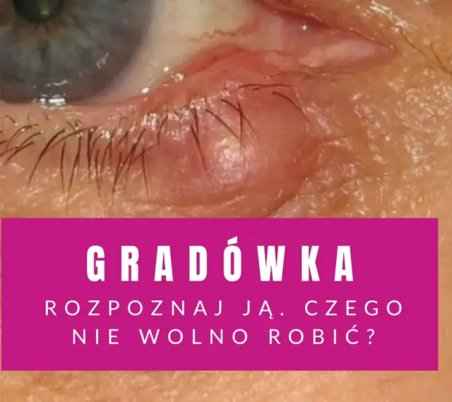Widoczna gradówka wewnątrz powieki, czerwona i opuchnięta. Tekst informuje o rozpoznawaniu i postępowaniu.