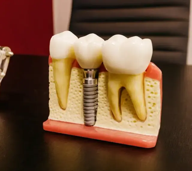 Model szczęki z zębami i mikroimplantem ortodontycznym. Implant zastępuje korzeń zęba, zapewniając stabilne podparcie dla korony.