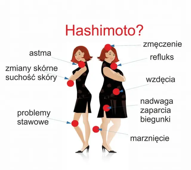 Hashimoto objawy psychiczne - jak rozpoznać i zrozumieć ich wpływ