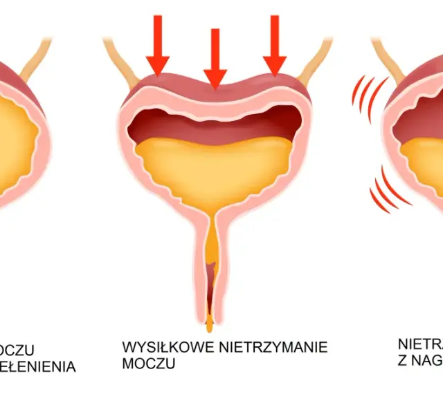 Ilustracja pokazuje trzy rodzaje popuszczania moczu: przepełnienie pęcherza, wysiłkowe i nagłe parcia.