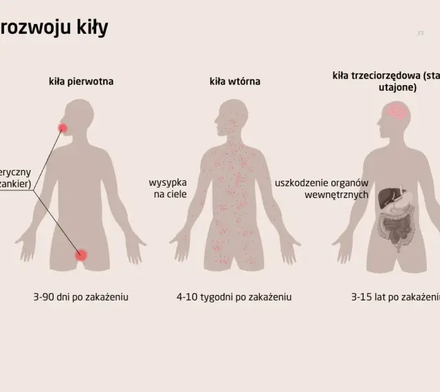 Ilustracja pokazuje stadia rozwoju kiły: pierwotne (wrzód), wtórne (wysypka) i trzeciorzędowe (uszkodzenie organów).