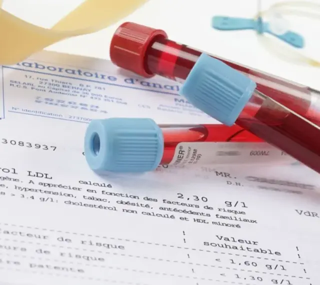 Próbki krwi w probówkach leżą na wynikach badań, gdzie widnieje m.in. poziom cholesterolu LDL. Wyniki mogą wskazywać na potrzebę monitorowania białka c reaktywnego.