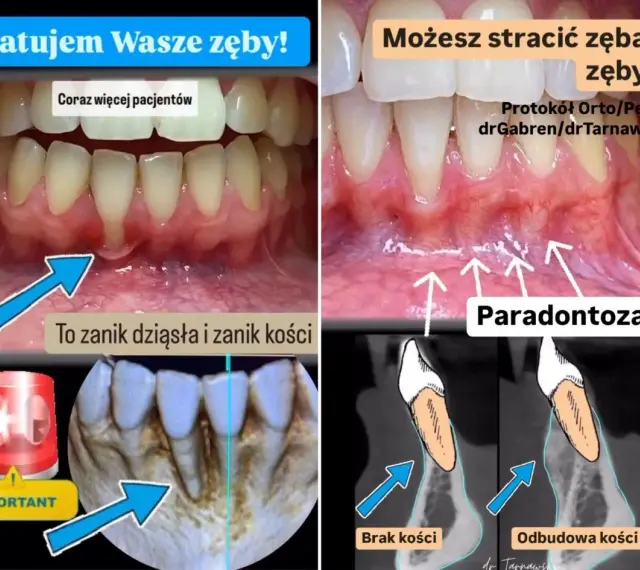 Widoczne odsłonięte szyjki zębowe, zanik dziąseł i kości. Paradontoza prowadzi do utraty zębów.