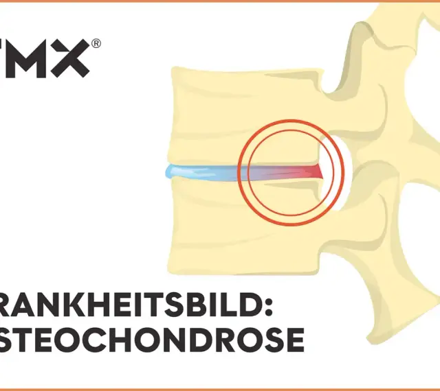 Darstellung eines Wirbels mit Bandscheibenschaden. Bei Osteochondrose wie geht es weiter? TMX Logo.