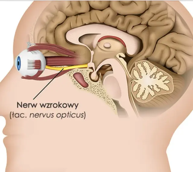 Przekrój głowy ukazujący oko i mózg. Widoczny jest żółty nerw wzrokowy łączący oko z mózgiem.