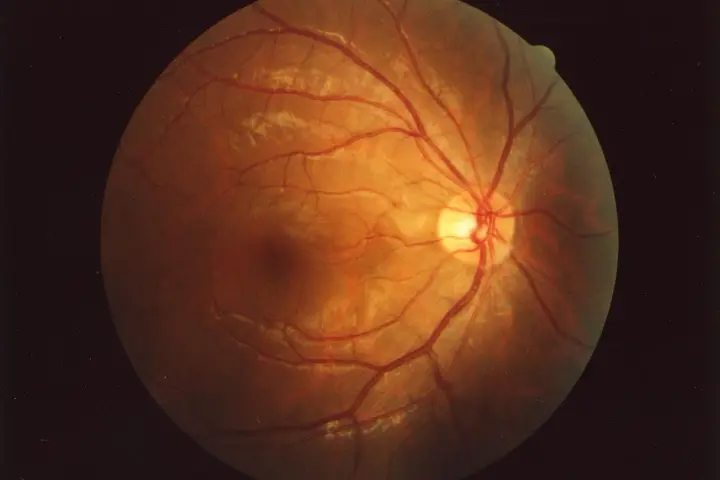 Il fundus oculi cos'è? Un'immagine della retina con vasi sanguigni rossi e aree biancastre, rivelando la sua complessa struttura interna.