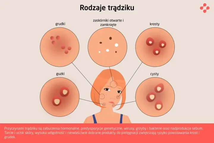 Ilustracja przedstawia różne rodzaje trądziku: grudki, zaskórniki, krosty, guzki i cysty.