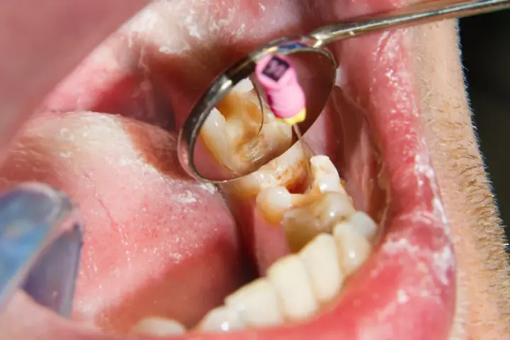 Dentysta podczas leczenia kanałowego zęba. W odbiciu lusterka widać narzędzie stomatologiczne i różowy kołeczek z oznaczeniem rozmiaru.