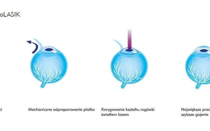 Korekcja krótkowzroczności: Od okularów po laser wybierz mądrze!