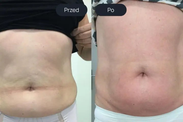 Porównanie brzucha przed i po endermologii. Widoczne wygładzenie skóry i redukcja tkanki tłuszczowej – spektakularne endermologia brzuch efekty.