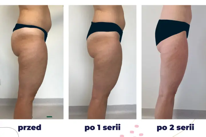 Efekty zabiegu iCoone na uda: przed, po 1 i po 2 seriach. Widoczna redukcja cellulitu i poprawa jędrności skóry.
