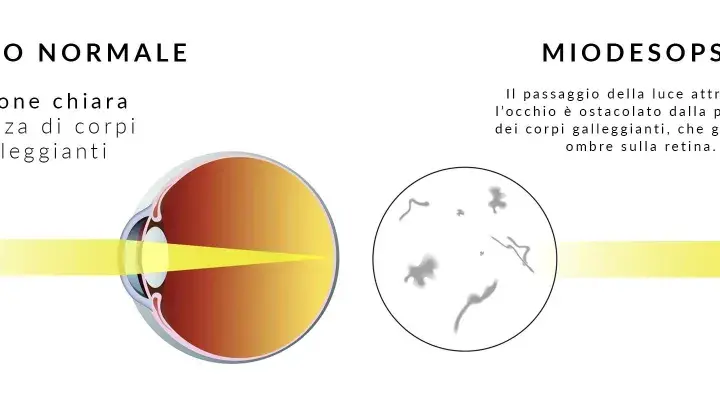 Confronto occhio normale e miodesopsia: corpi galleggianti nel vitreo ostacolano la luce. Ricerca cure naturali per il distacco del vitreo.
