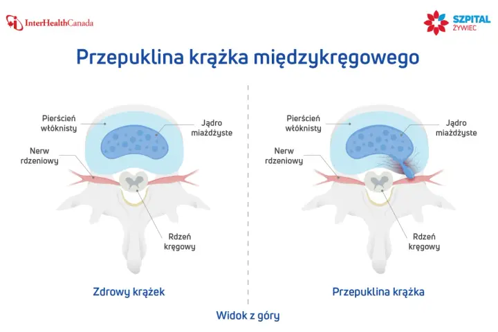 Porównanie zdrowego krążka międzykręgowego z przepukliną krążka szyjnego z uciskiem na worek oponowy.