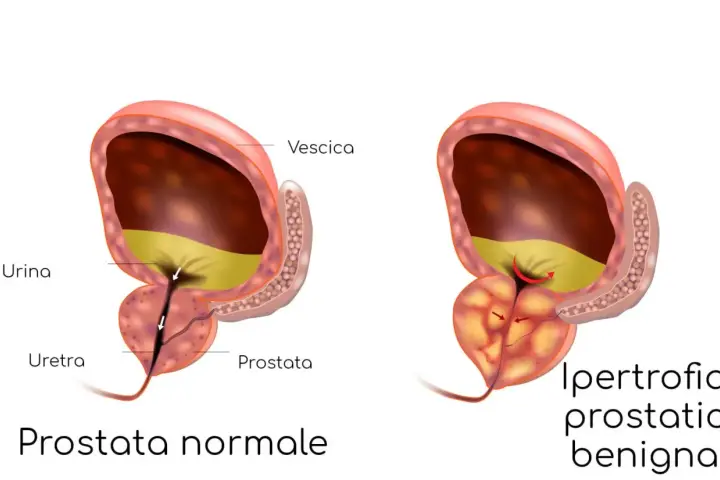 Confronto tra prostata normale e prostata infiammata, dove l'ipertrofia prostatica benigna comprime l'uretra, ostacolando il flusso urinario.
