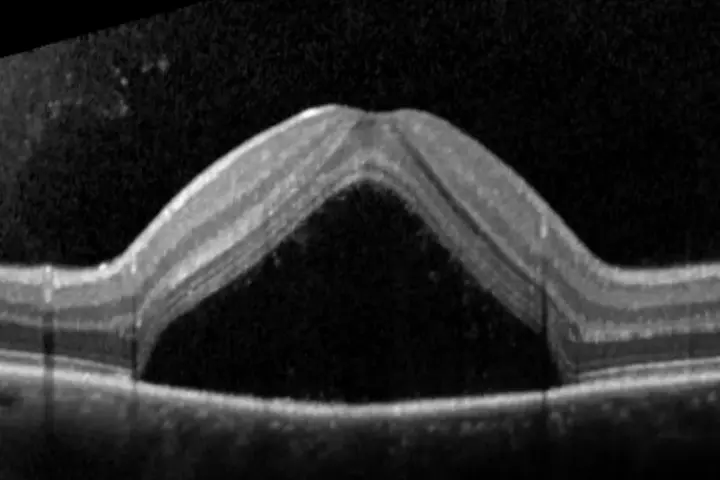 OCT di occhio con corioretinopatia sierosa centrale. Evitare stress e cortisone per non peggiorare la condizione.