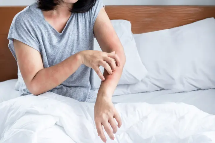 Frau kratzt sich am Arm, rote Hautstellen. Juckende Haut kann ein Symptom der Wechseljahre sein.