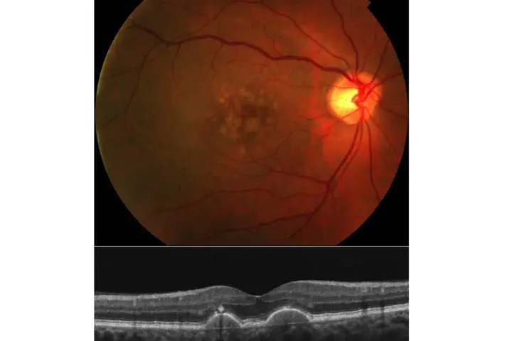 Immagine OCT e fondo oculare che mostrano segni di degenerazione maculare, il cui significato è cruciale per la diagnosi.