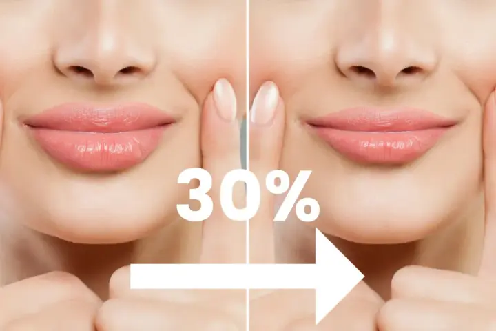 Przed i po zabiegu powiększania ust. Widoczny efekt 30% większej objętości.