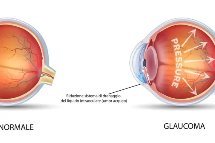 Confronto tra occhio normale e occhio con glaucoma. L'immagine mostra come la pressione elevata nel glaucoma danneggi il nervo ottico.
