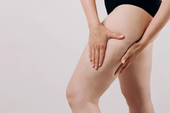 Une femme touche sa cuisse, montrant les capitons de la cellulite.