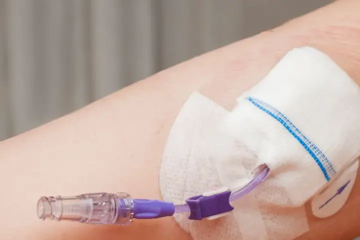 Cewnik do żywienia pozajelitowego podłączony do ręki. Zapewnia niezbędne składniki odżywcze, gdy tradycyjne żywienie jest niemożliwe.