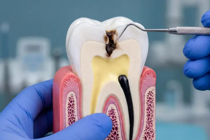 Model zęba pokazuje zaawansowaną próchnicę, która dotarła do miazgi. Dentysta w niebieskiej rękawiczce bada ubytek.