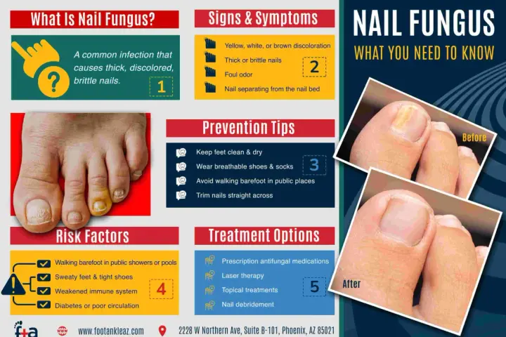 Infographie sur le vernis mycose : causes, symptômes, prévention et traitements. Avant/après montrant l'amélioration d'un ongle atteint.