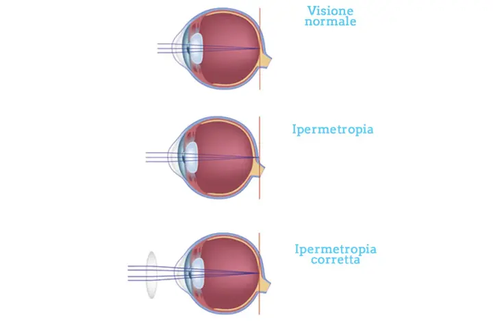 Illustrazione dell'ipermetropia oculare: visione normale, ipermetropia e correzione con lente.