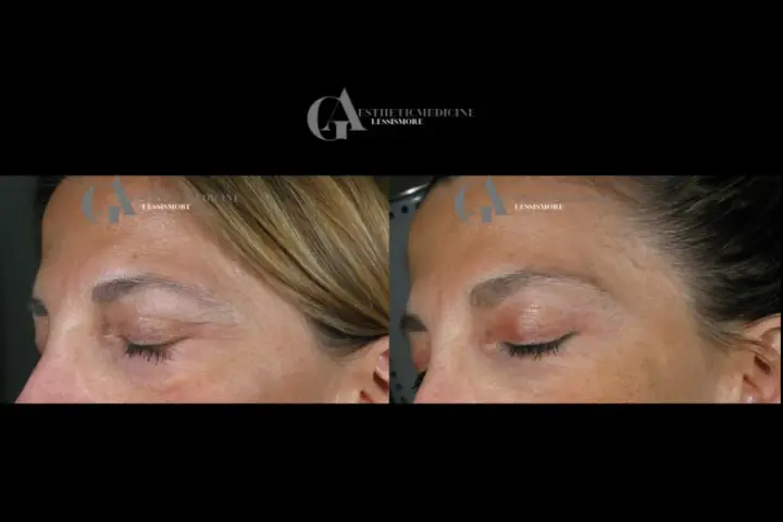 Confronto botox viso prima e dopo: rughe attenuate sulla fronte e contorno occhi più disteso.