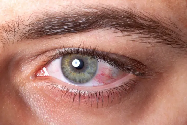 Czerwone, podrażnione oko z widocznymi naczynkami, jakby wpadło uczucie piasku w oczach.
