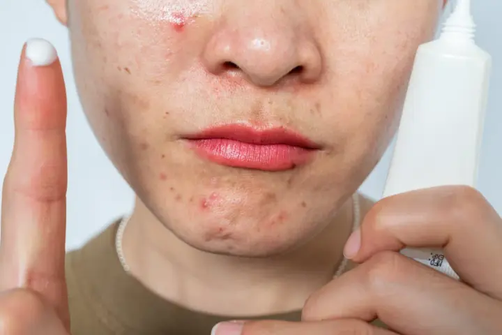 A person's face shows acne and redness, possibly from retinol burn. A finger with cream and a tube of skincare product are visible.