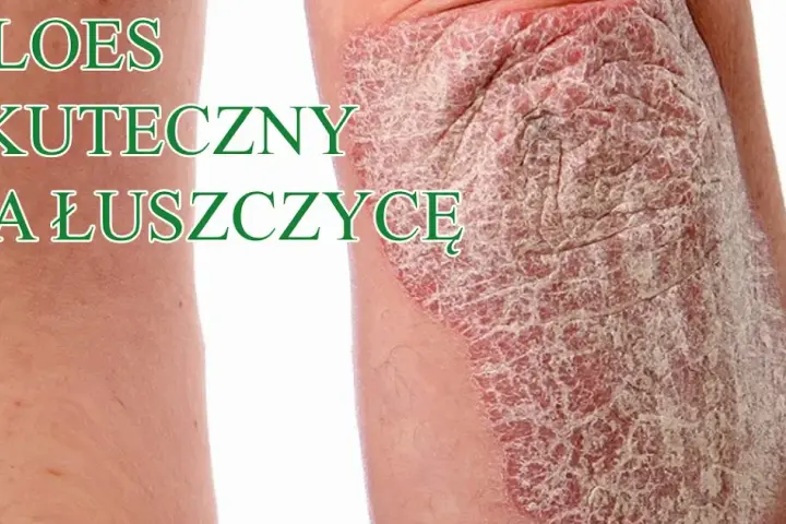 Czy jest nowy lek na łuszczycę? Odkryj najnowsze terapie i ich skuteczność