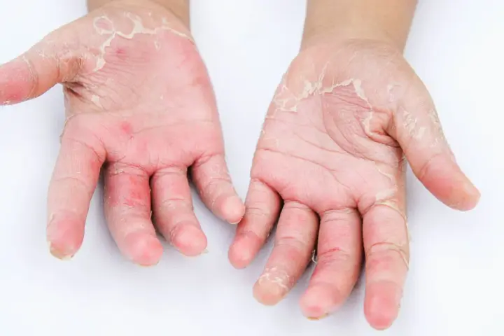 Mani con evidente desquamazione della pelle, arrossamento e secchezza. La pelle appare irritata e screpolata.