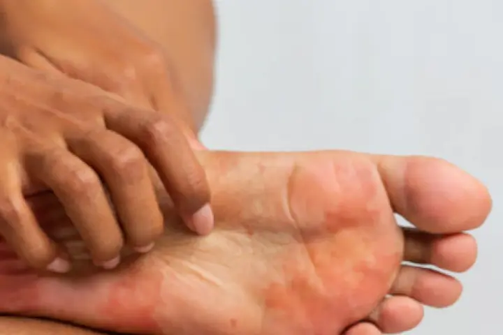 Una persona se rasca el pie, mostrando enrojecimiento e irritación. ¿Cómo saber si tengo hongos en los pies?
