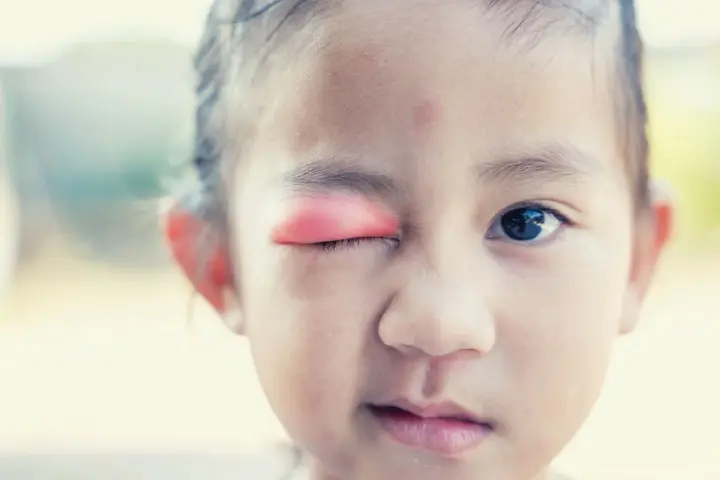 Bambina con occhio gonfio e arrossato, possibile segno di infezione o allergia. Le cause degli occhi gonfi nei bambini sono varie.
