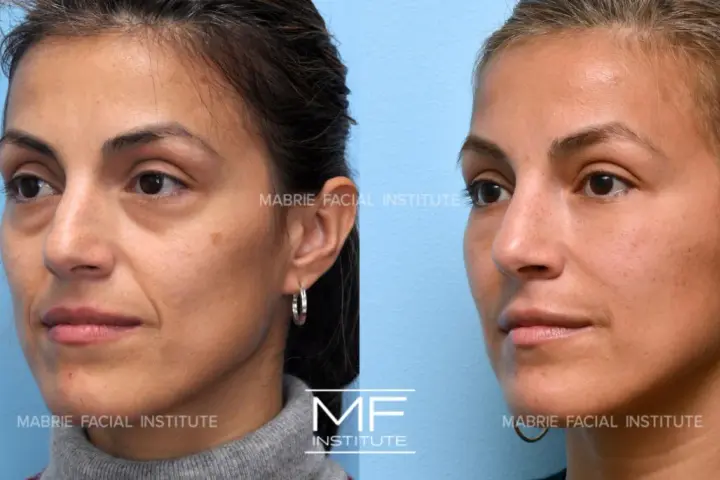 Before and after images show a woman's face, highlighting the reduction of nasolabial folds after a facial massage.