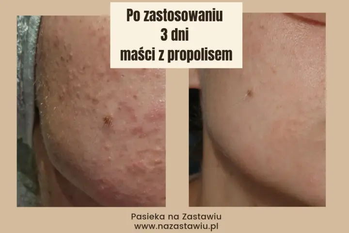 Przed i po zastosowaniu maści z propolisem: skóra z niedoskonałościami po 3 dniach kuracji wygląda znacznie lepiej.