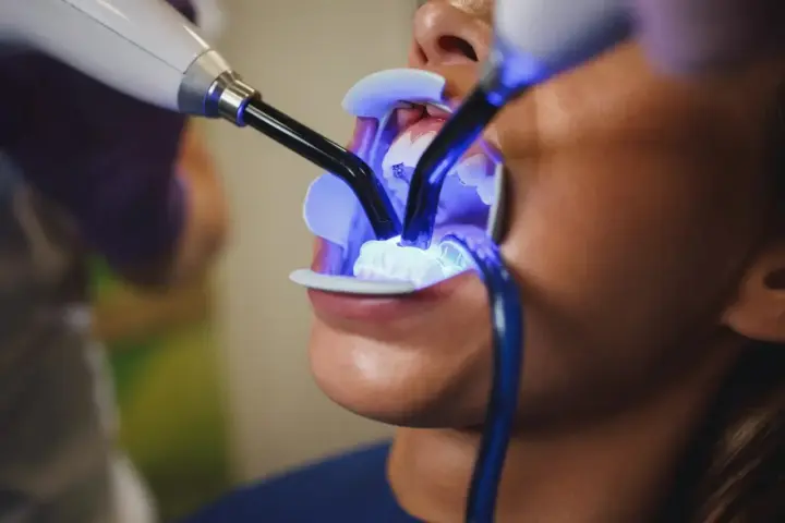 Jak wygląda wybielanie zębów u dentysty? Przewodnik krok po kroku